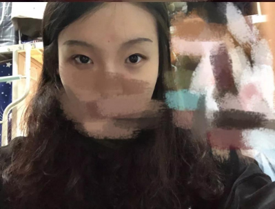 做雙眼皮案例，北京藝星張順慶雙眼皮案例圖片