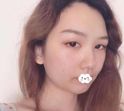 武漢伊萊美割雙眼皮怎么樣？切開(kāi)雙眼皮恢復(fù)過(guò)程圖