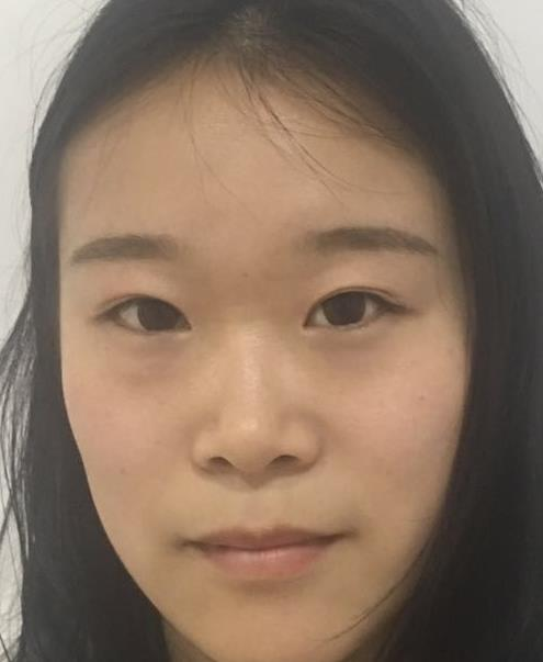 石家莊諾萬整形肋軟骨隆鼻案例分享，恢復過程圖