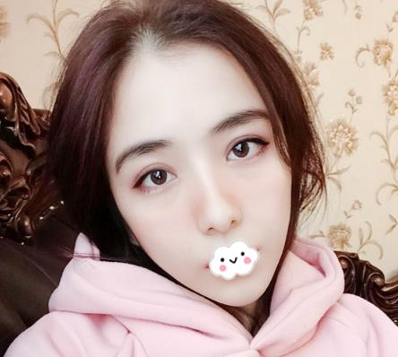 大連沙醫(yī)生整形付德林做的自體軟骨隆鼻效果，給大家做個參考