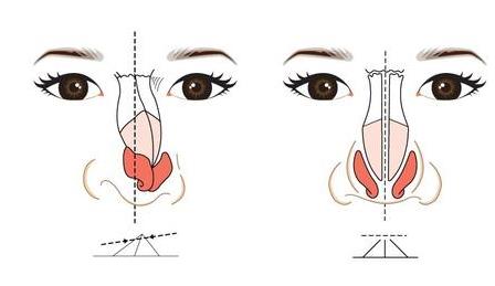 天津時光整形歪鼻矯正