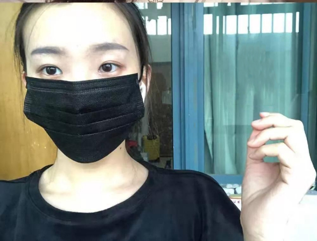 做雙眼皮案例，北京藝星張順慶雙眼皮案例圖片