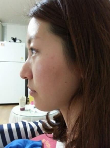 原來駝峰鼻整完這么好看，我再也不是丑美丑美的了