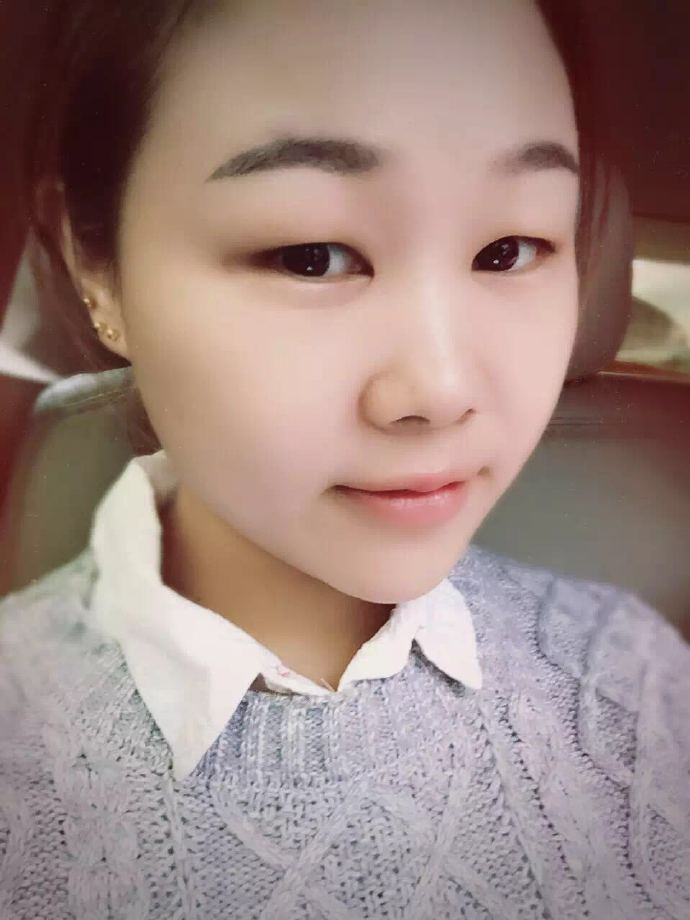 腫眼泡應(yīng)該做哪種雙眼皮？汕頭曙光雙眼皮三個(gè)月效果分享