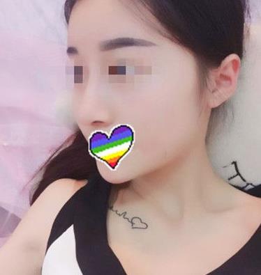 石家莊諾萬整形姚華榮硅膠隆鼻案例分享術(shù)后一個(gè)月效果