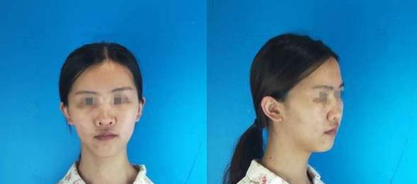 濱州醫(yī)學院附屬醫(yī)院做隆鼻術前效果 濱州醫(yī)學院附屬醫(yī)院做隆鼻術前效果