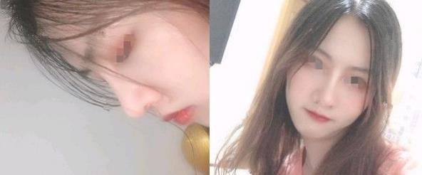 朋友推薦到濱州醫(yī)學(xué)院附屬醫(yī)院做隆鼻，效果還挺不錯(cuò)