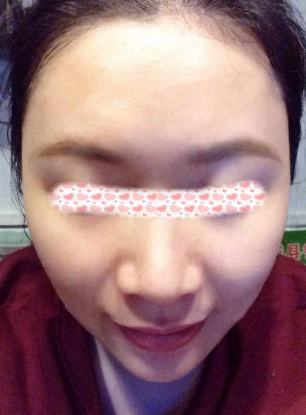 像我一樣寬鼻翼的小姐姐們可以放心找李旭平做隆鼻了，親測好評