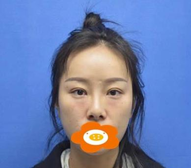 萬(wàn)萬(wàn)沒(méi)想到在鄭州禾麗做的肋軟骨隆鼻效果居然是這樣的