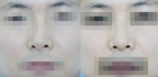 不要被營銷號帶偏了，鼻骨矯正其實很簡單