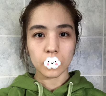 大連沙醫(yī)生整形付德林做的自體軟骨隆鼻效果，給大家做個參考