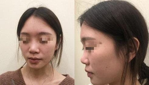 耳軟骨隆鼻術后三個月，我有了韓佳人同款美鼻