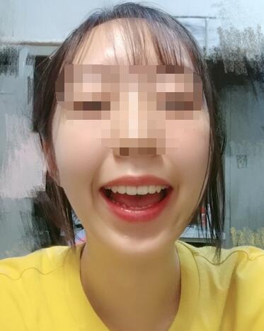 昆山禾豐口腔牙齒矯正案例牙齒矯正結(jié)束