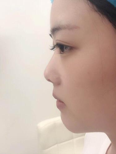 廈門海峽整形鼻綜合案例分享，這鼻子可以滑滑梯了