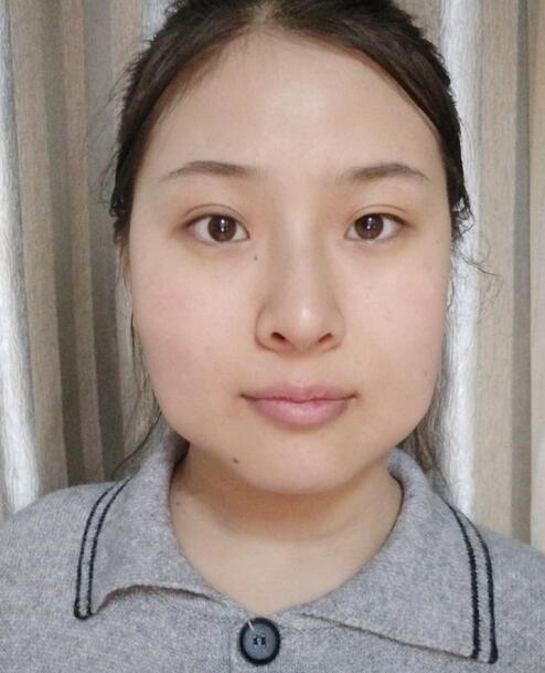 杭州時(shí)光磨骨前后對比，你整成這樣還缺王思聰嗎