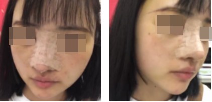 哈爾濱成美整形周小生鼻綜合案例術(shù)后兩天 哈爾濱成美整形周小生鼻綜合案例術(shù)后兩天