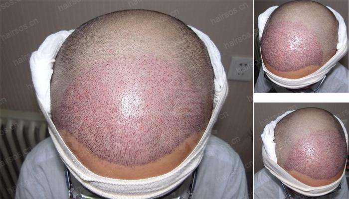 南京美貝爾發(fā)際線種植案例分享，不僅年輕還顯臉小