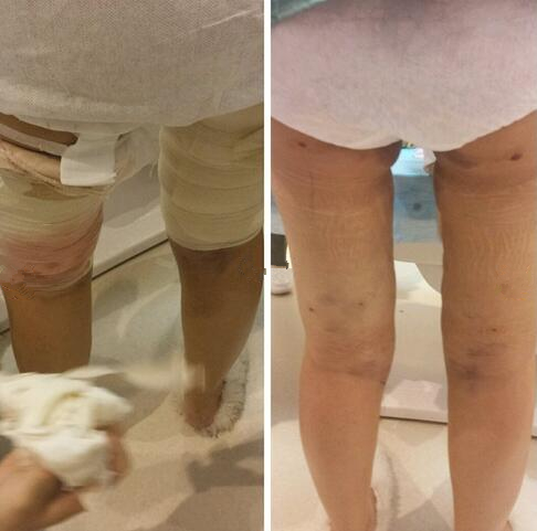 不做一次大腿吸脂永遠都不知道你瘦下來原來這么美