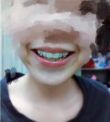 昆山禾豐口腔牙齒矯正案例牙齒即將排齊