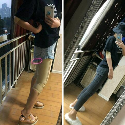 成都趙博士整形大腿吸脂案例一個月效果