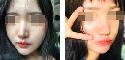 一個鼻子讓一張臉迅速高級，還不考慮做個鼻綜合嗎