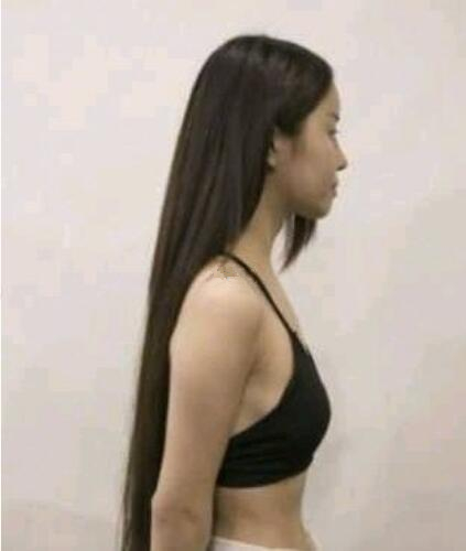 濟(jì)南海峽整形假體隆胸半年效果，夏天就是拼身材的時(shí)候