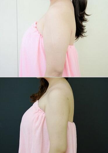 揭陽美萊整形手臂吸脂案例術(shù)前效果 揭陽美萊整形手臂吸脂案例術(shù)前效果