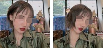 哈爾濱成美整形周小生鼻綜合案例術(shù)后兩個(gè)月 哈爾濱成美整形周小生鼻綜合案例術(shù)后兩個(gè)月