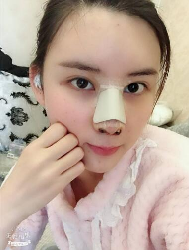 這么好的效果，不來蘭州美月做膨體隆鼻真是白瞎了醫(yī)生的技術(shù)