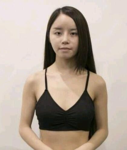 濟(jì)南海峽整形假體隆胸術(shù)前側(cè)面