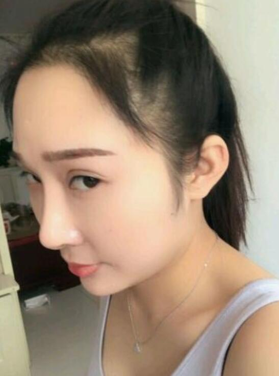 溫州新生植發(fā)種植發(fā)際線案例反饋，與大腦門說拜拜