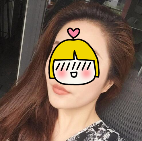 南京藝星整形趙海波面部吸脂術(shù)后一個(gè)月 南京藝星整形趙海波面部吸脂術(shù)后一個(gè)月