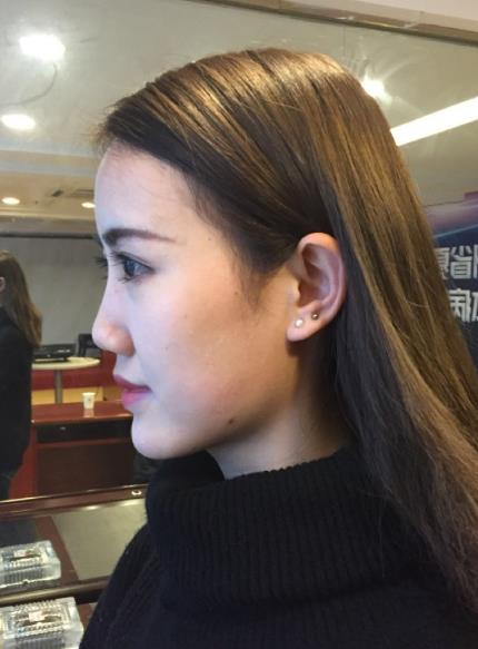 北京藝美整形鼻綜合案例分享，我都忍不住多看了兩眼