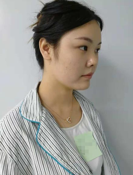 長沙雅美眼鼻整形案例分享，術(shù)后這滿滿的混血感是腫么回事