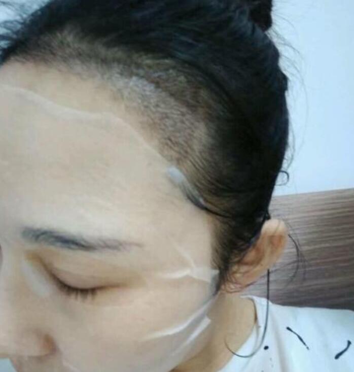 溫州新生植發(fā)種植發(fā)際線案例術(shù)后一個(gè)月效果