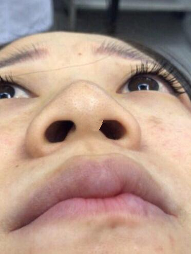 深圳福華整形陳貞宜超體隆鼻術(shù)后一個(gè)月效果反饋，有圖