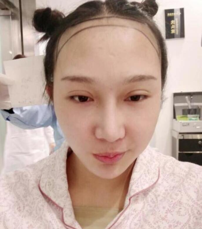 溫州新生植發(fā)種植發(fā)際線案例反饋，與大腦門說拜拜