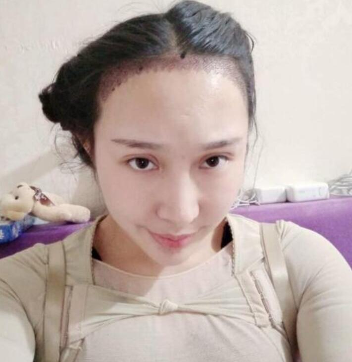 溫州新生植發(fā)種植發(fā)際線案例術(shù)后一周效果