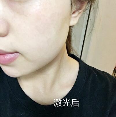 紹興維美整形激光祛斑兩個療程后