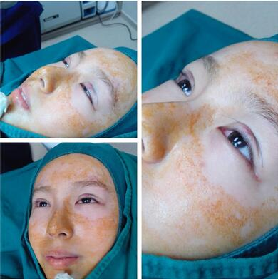 萍鄉(xiāng)麗芙整形埋線雙眼皮三個月效果分享，完全看不出來是做的