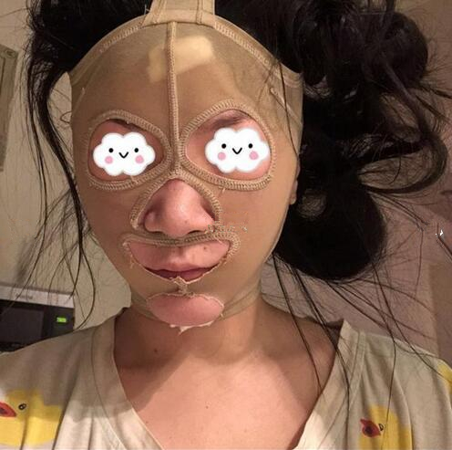 南京藝星整形趙海波面部吸脂術(shù)后一周 南京藝星整形趙海波面部吸脂術(shù)后一周