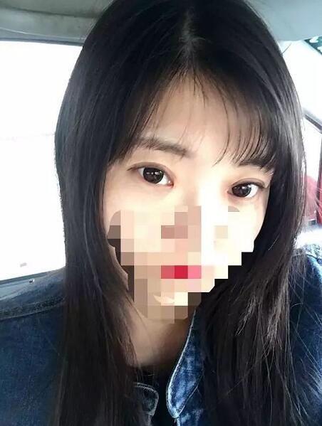 北京京民雙眼皮修復案例術后兩個月 北京京民雙眼皮修復案例術后兩個月