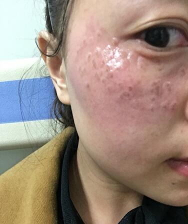 紹興維美整形激光祛斑兩個療程，皮膚像剝了殼的雞蛋