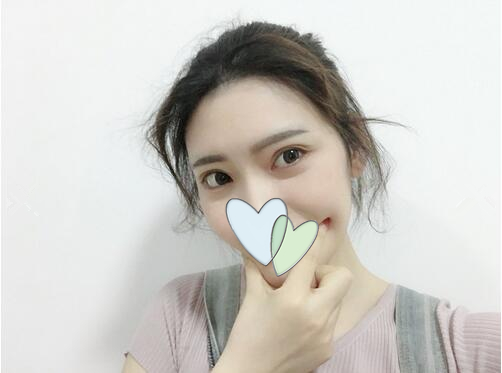 哈爾濱成美自體脂肪全臉填充案例，果然還是飽滿顯年輕