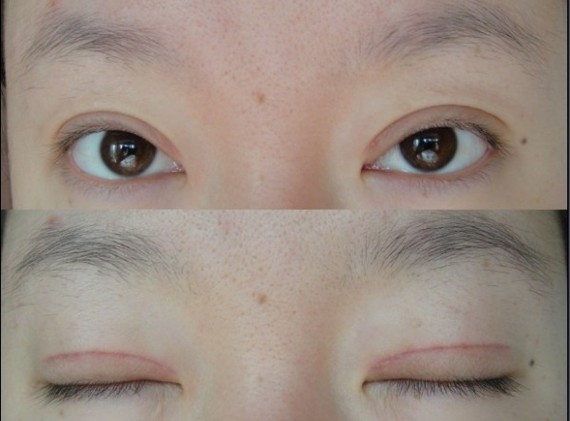 鄭州望京做全切雙眼皮+開外眼角半個(gè)月