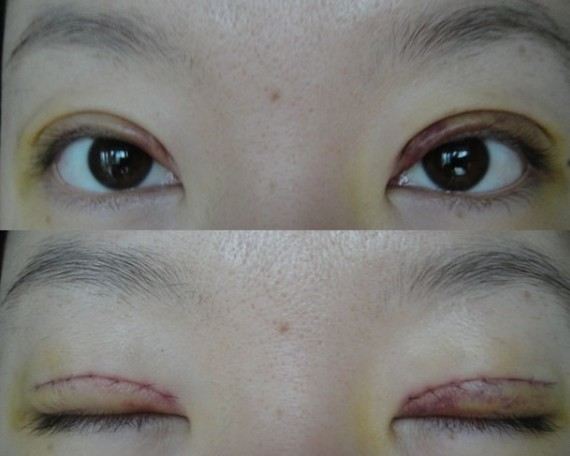 在鄭州望京做全切雙眼皮+開外眼角，術(shù)后效果確實(shí)沒(méi)讓我失望