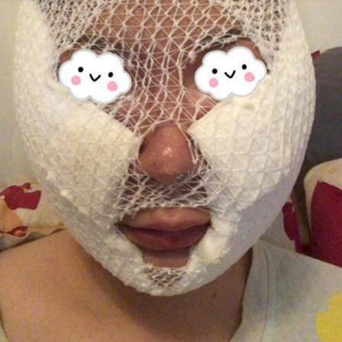 南京藝星整形趙海波面部吸脂術(shù)后第二天 南京藝星整形趙海波面部吸脂術(shù)后第二天