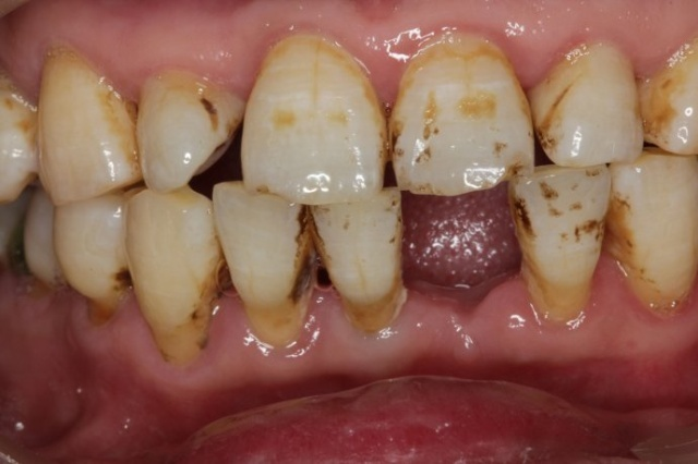 深圳正夫口腔種植牙案例分享，這下可以好好吃飯了