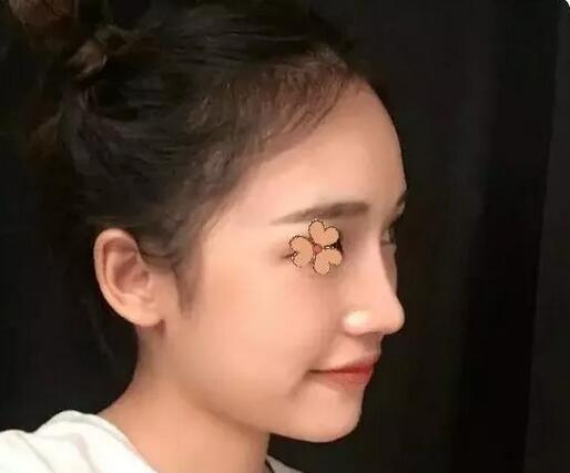 深圳福華整形陳貞宜超體隆鼻術(shù)后一個(gè)月效果反饋，有圖