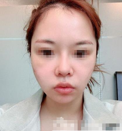 南京閱顏整形瘦臉針注射后三天